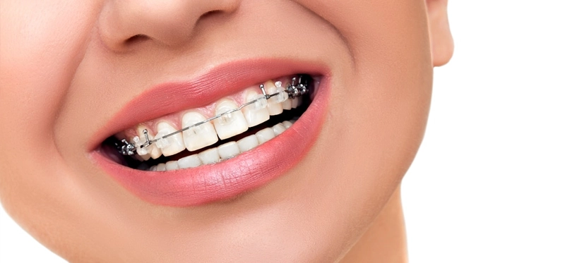 Braces Treatment In Bilaspur
