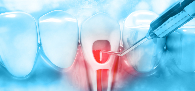 Root Canal Treatment in Bilaspur