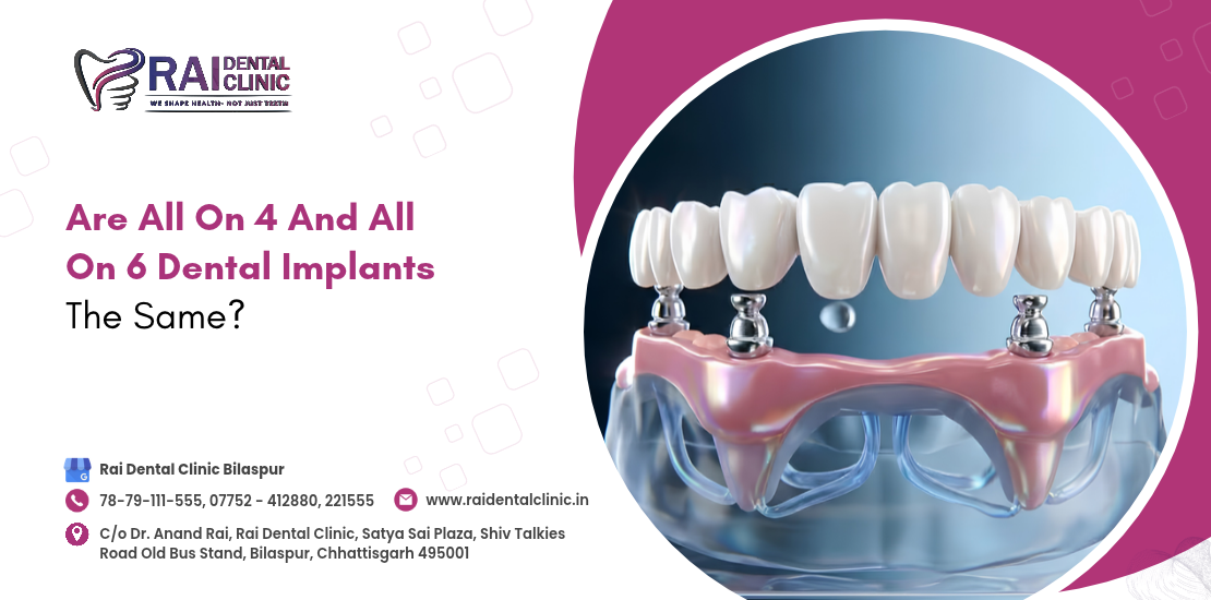 Are All On 4 And All On 6 Dental Implants The Same ?