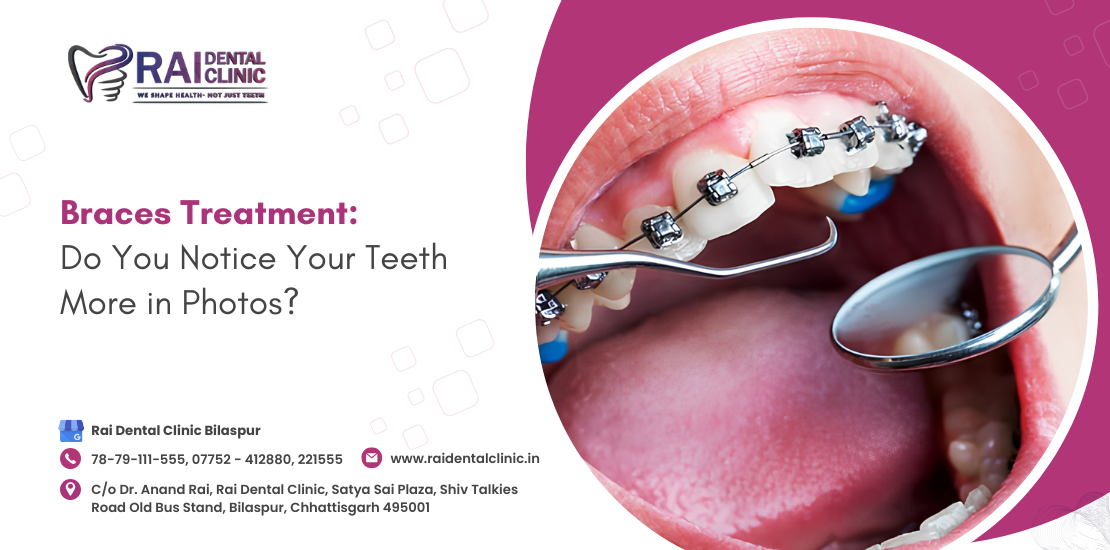braces treatment in Bilaspur