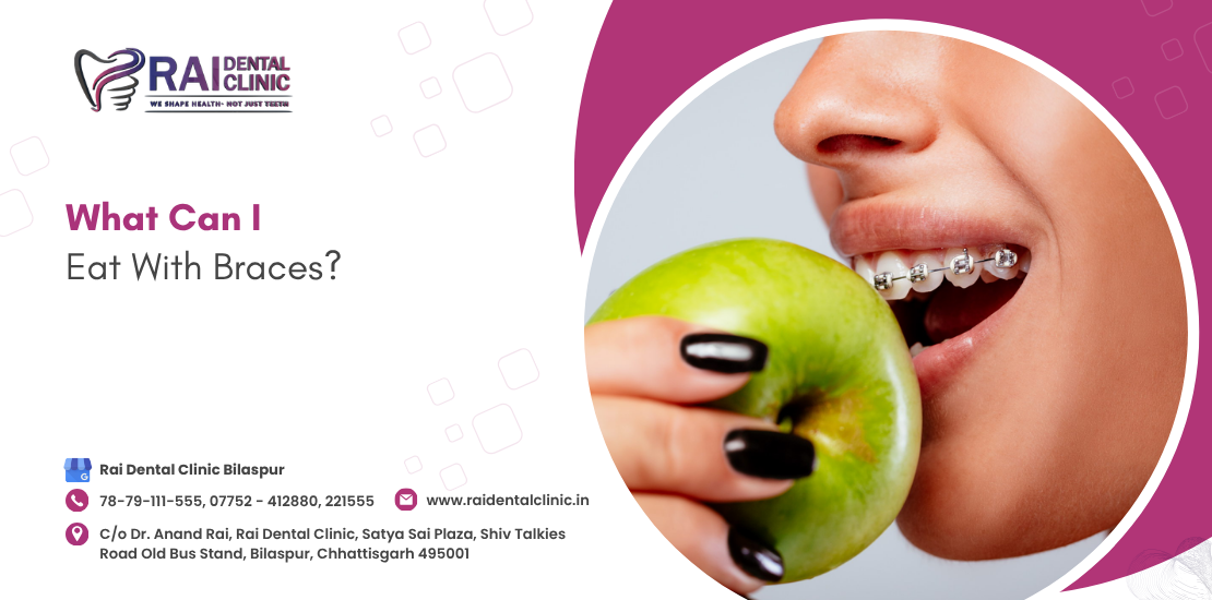 What Can I Eat With Braces?
