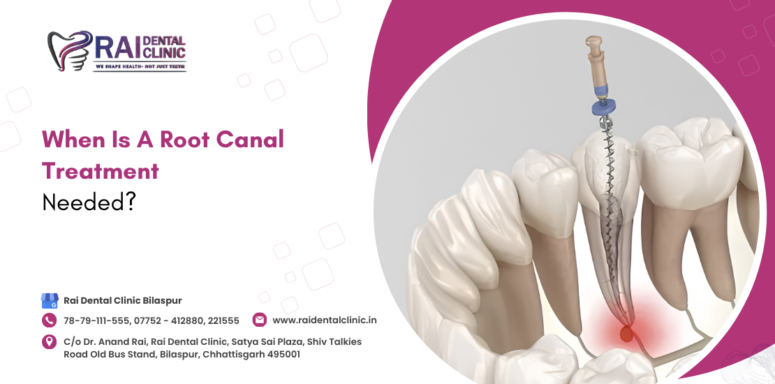 When Is A Root Canal Treatment Needed ?