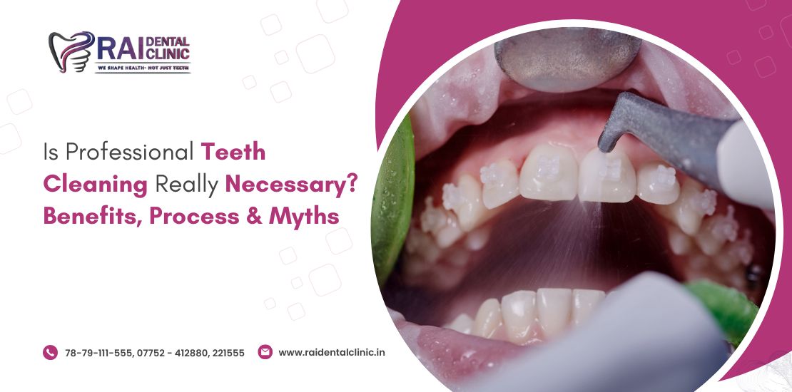 teeth cleaning in bilaspur