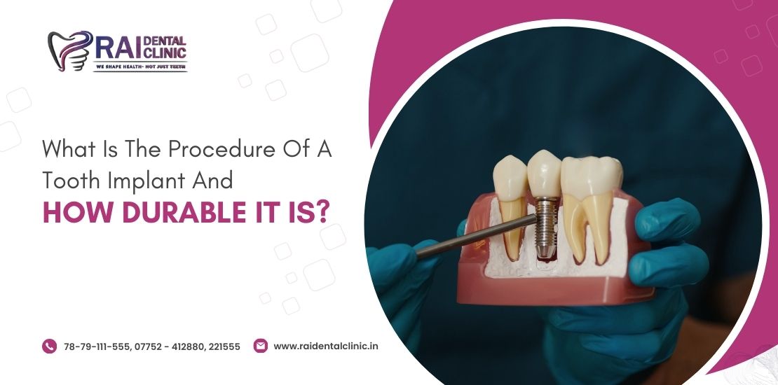 dental implant treatment in Bilaspur